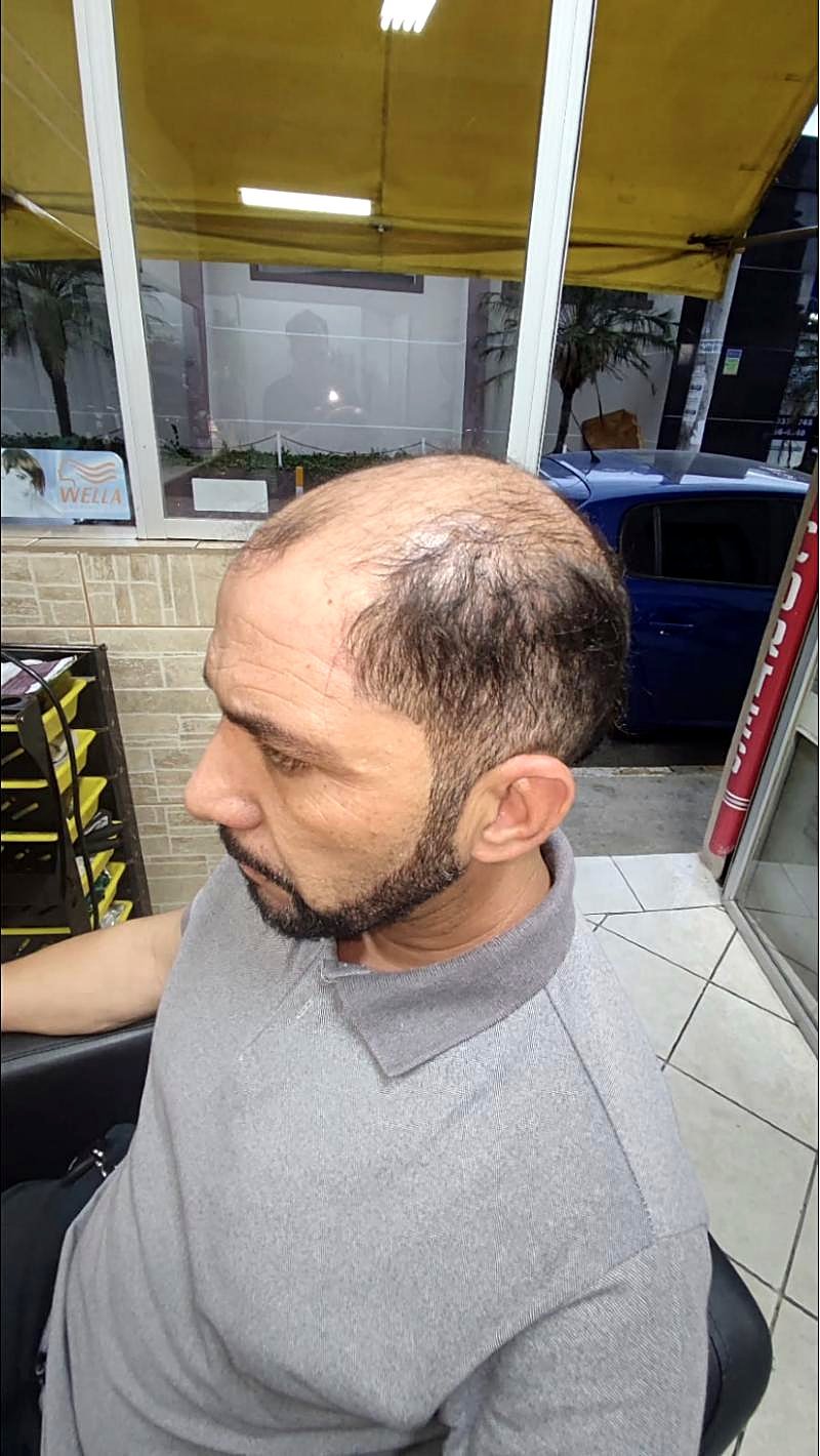 Cliente antes, com calvície no topo, visto de lado